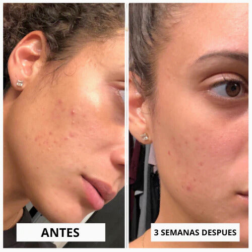 ALTA FRECUENCIA PORTATIL FACIAL Y CAPILAR PRO 4 EN 1✅