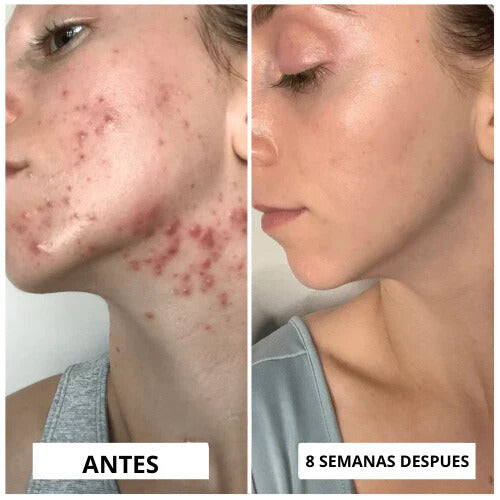 ALTA FRECUENCIA PORTATIL FACIAL Y CAPILAR PRO 4 EN 1✅