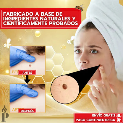 💧🔥 TAG RECEDE ELIMINADOR DE VERRUGAS 🔥💧